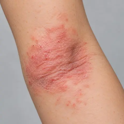 Dokumentasi perawatan eksim dermatitis sebelum