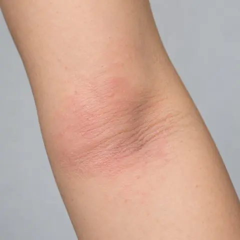 Dokumentasi perawatan eksim dermatitis sesudah