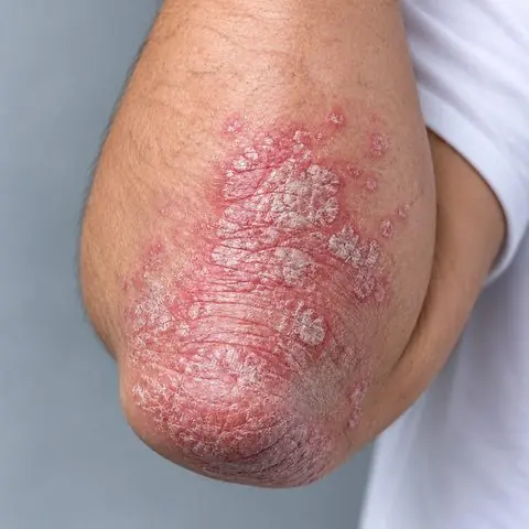 Dokumentasi perawatan psoriasis sebelum