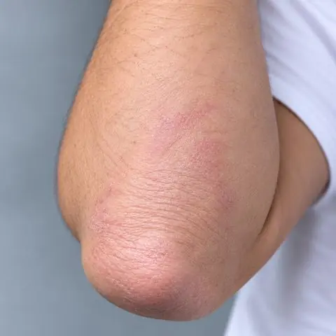 Dokumentasi perawatan psoriasis sesudah