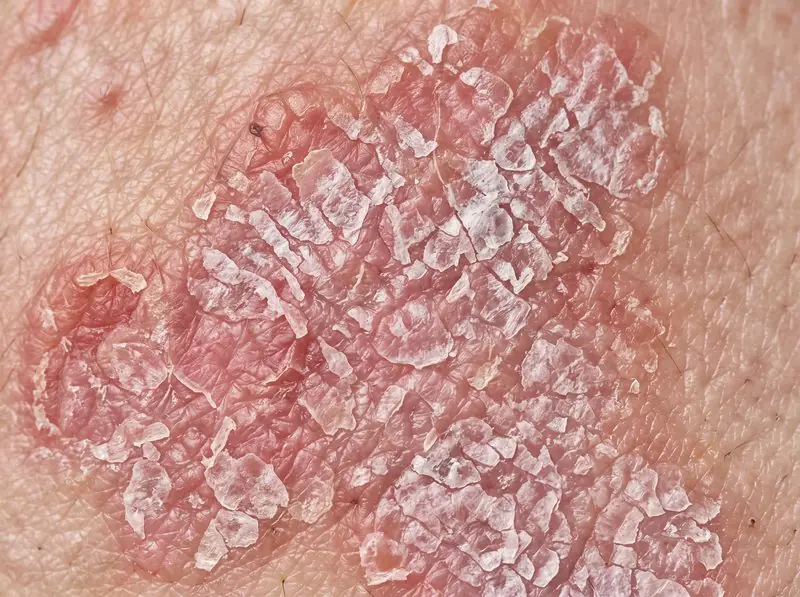 Penyakit kulit psoriasis