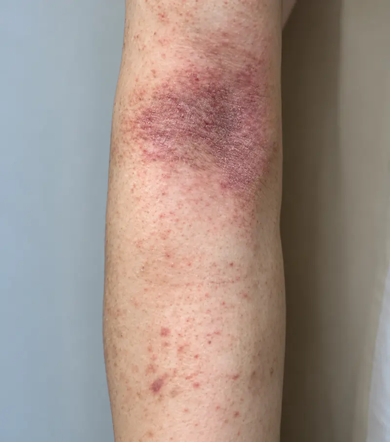 Image psoriasis before