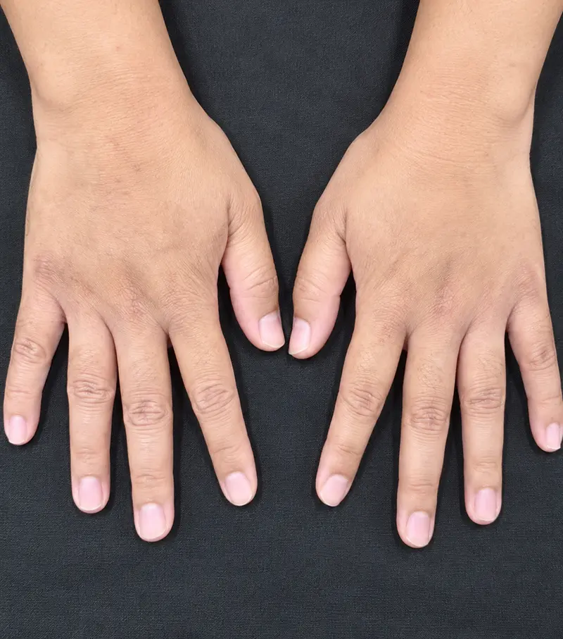 Image dermatitis after