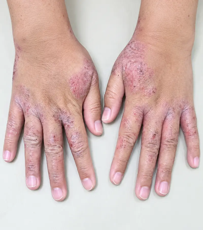 Image dermatitis before