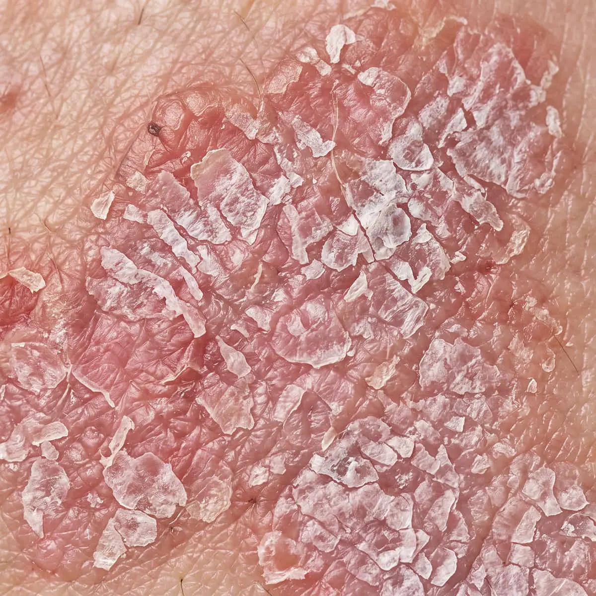 Psoriasis
